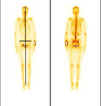 Patient with Height and Gluteal Region.jpg